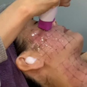 音波拉提,音波拉皮,臉部拉提,鳳凰電波