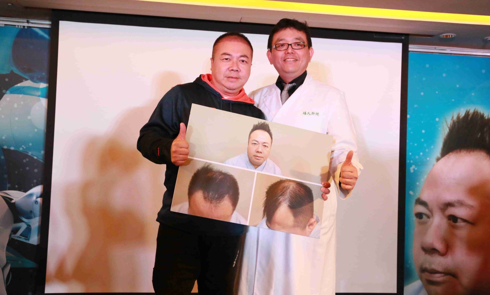 植髮,植鬍,植髮分享