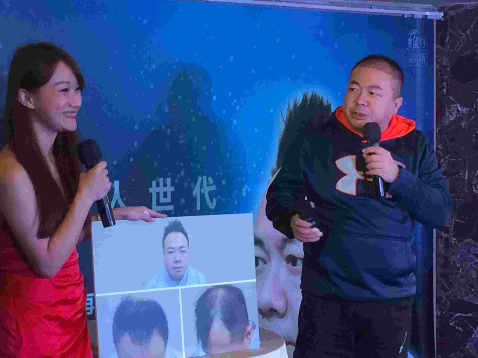 植髮,植鬍,植髮分享