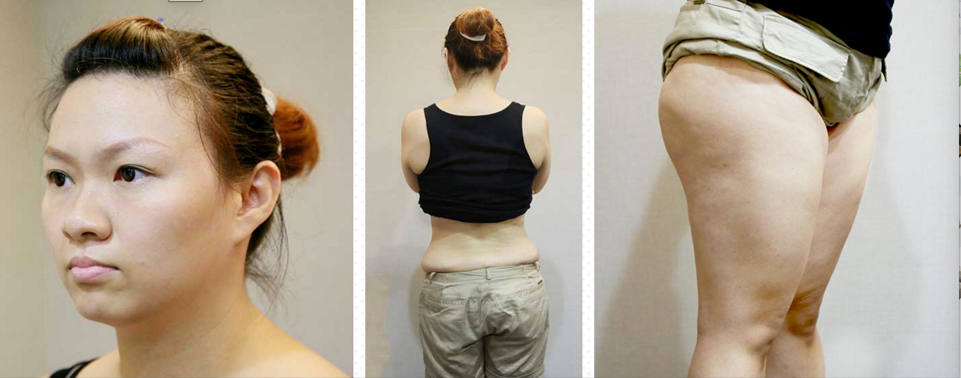 實在不可思議,整形,雷射減脂,醫美