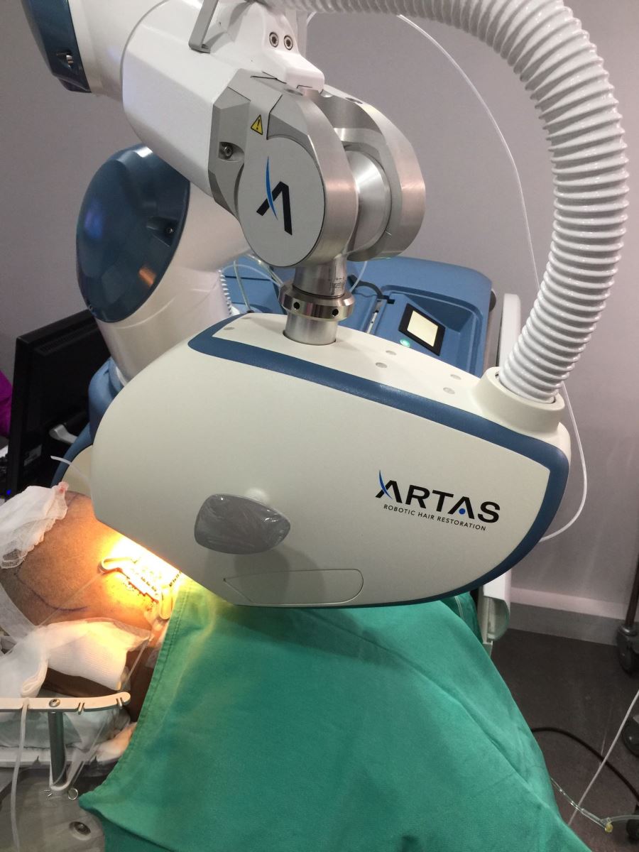 楊名權,ARTAS,ARTAS植髮,機器人植髮