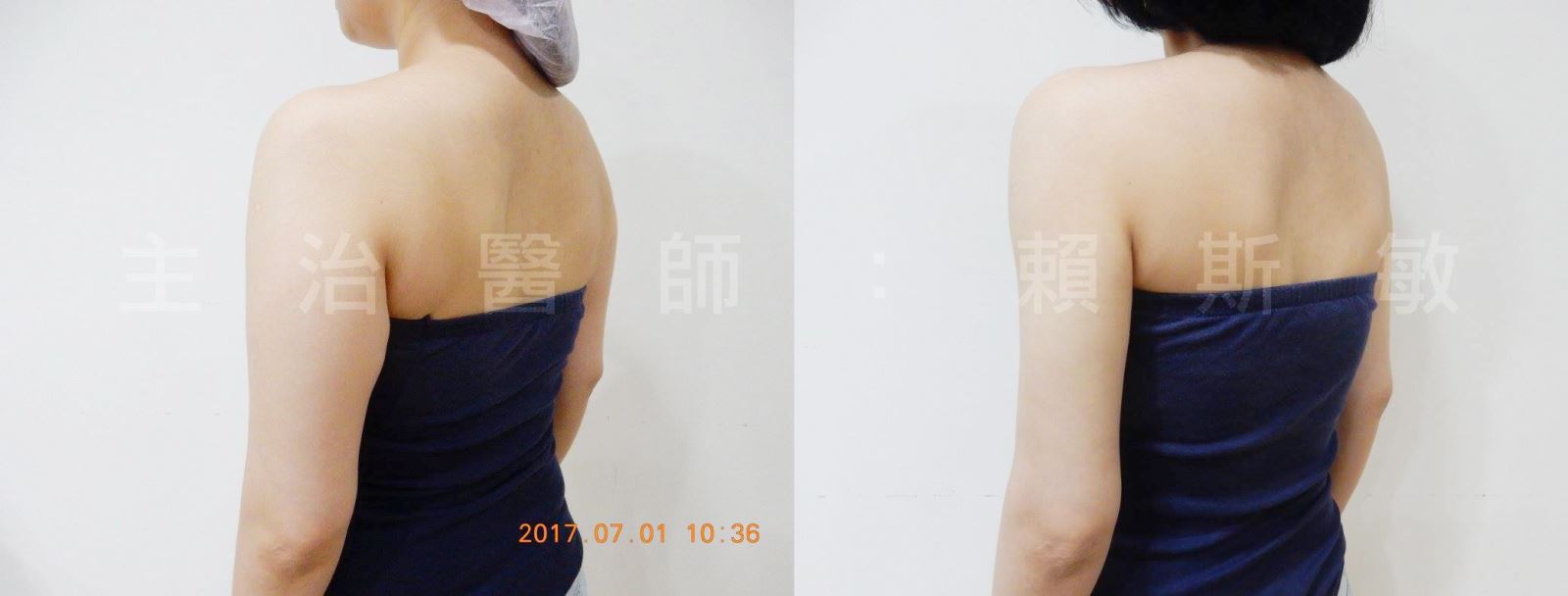 雷射減脂,消脂,體雕,瘦手臂