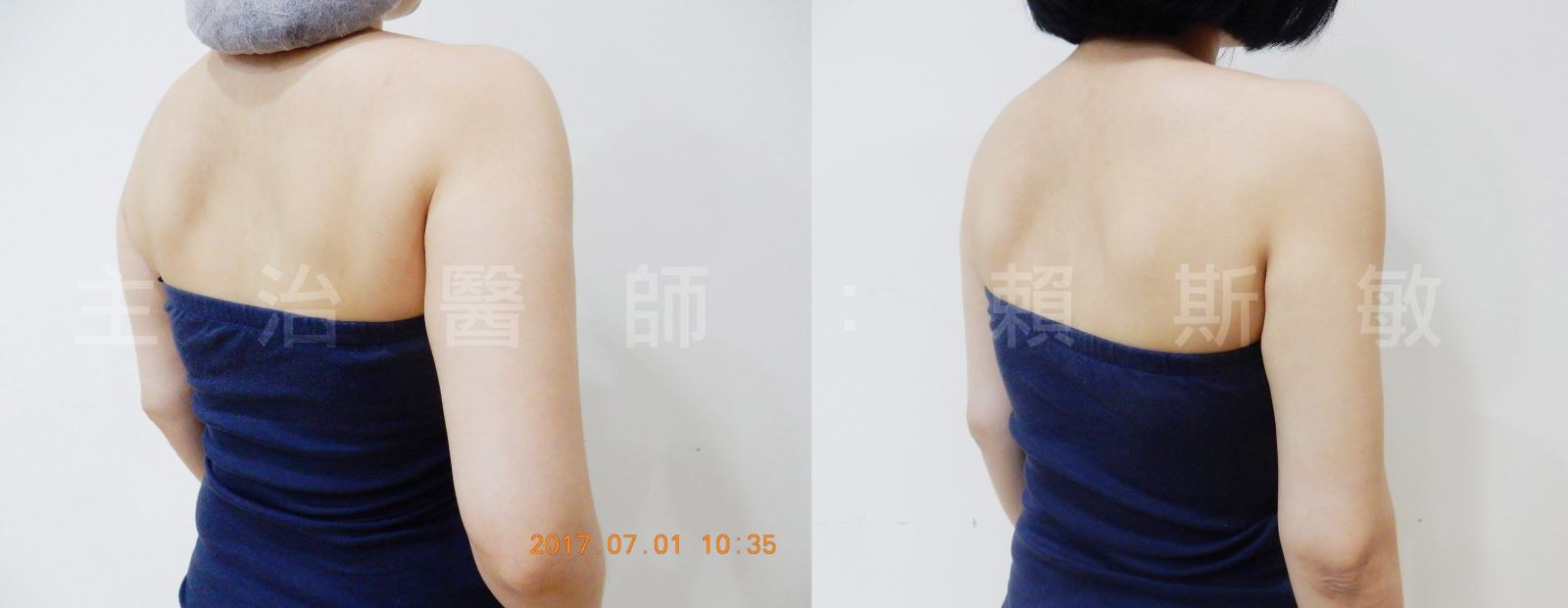 雷射減脂,消脂,體雕,瘦手臂
