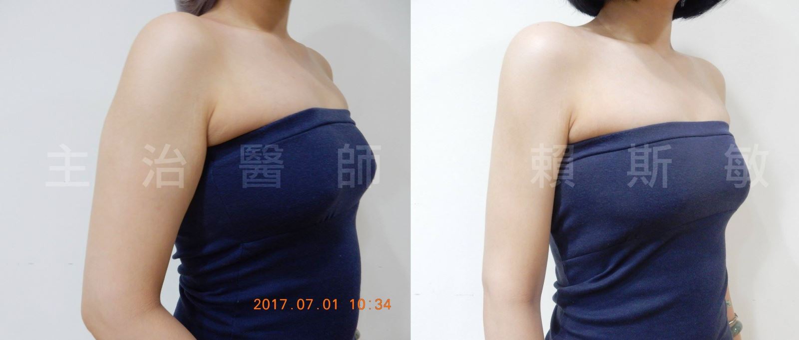 雷射減脂,消脂,體雕,瘦手臂