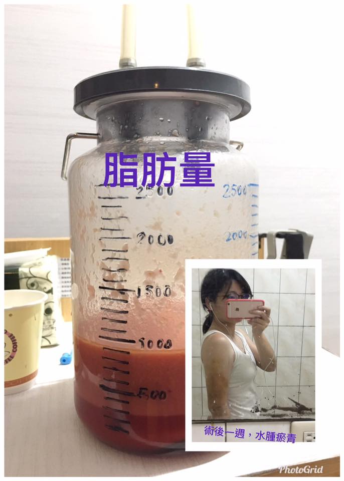 抽脂,瘦手臂,蝴蝶袖,掰掰袖,雷射減脂