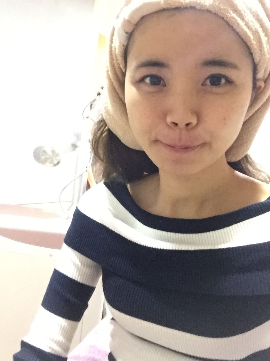 台北八倍淨膚雷射術前照 台北八倍淨膚雷射術前照