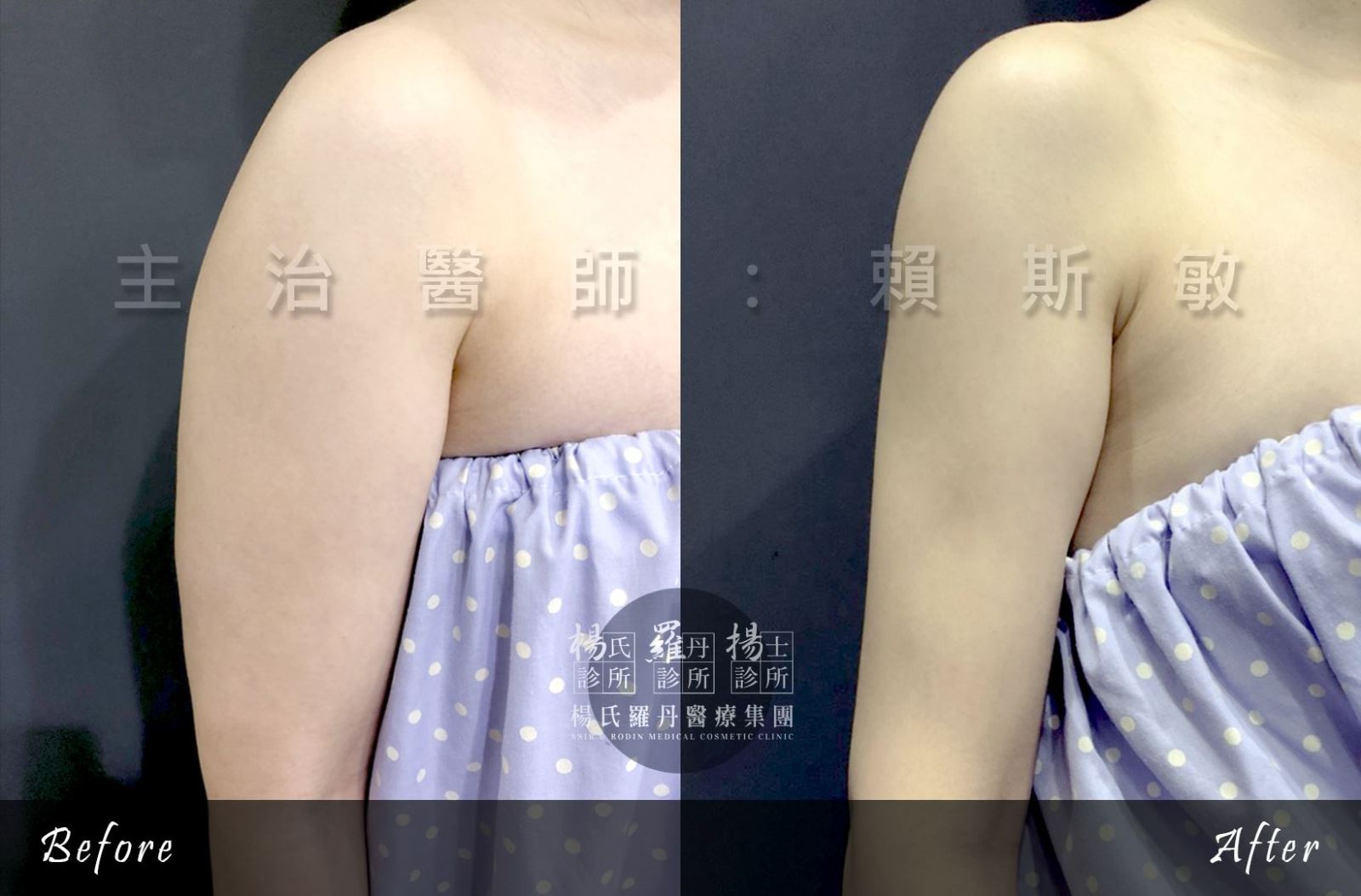 新竹台中高雄手臂抽脂瘦手臂術前術後 新竹台中高雄手臂抽脂瘦手臂術前術後