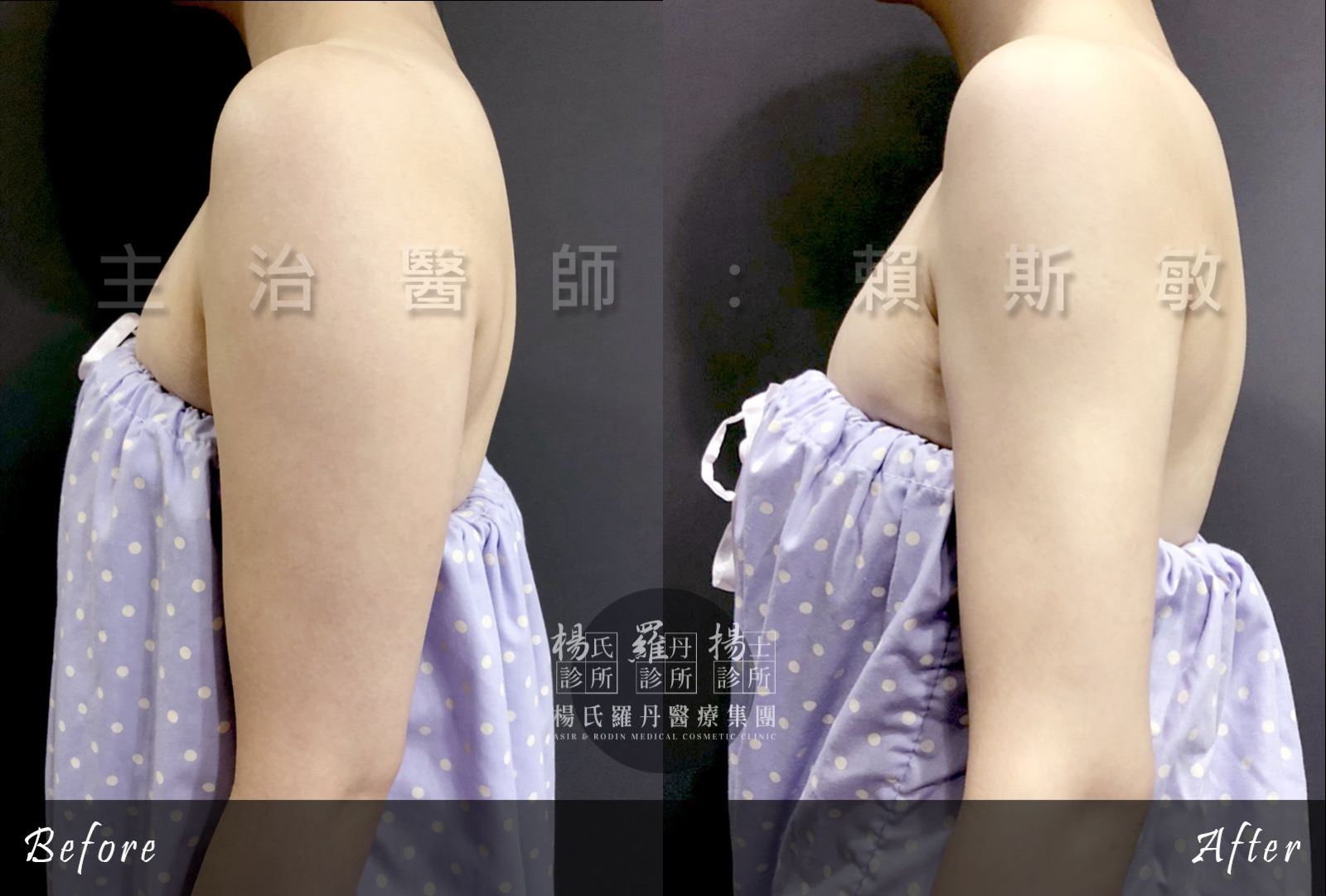 新竹台中高雄手臂抽脂瘦手臂術前術後 新竹台中高雄手臂抽脂瘦手臂術前術後