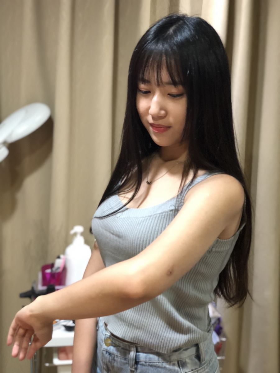 台北手臂抽脂瘦手臂術後一年