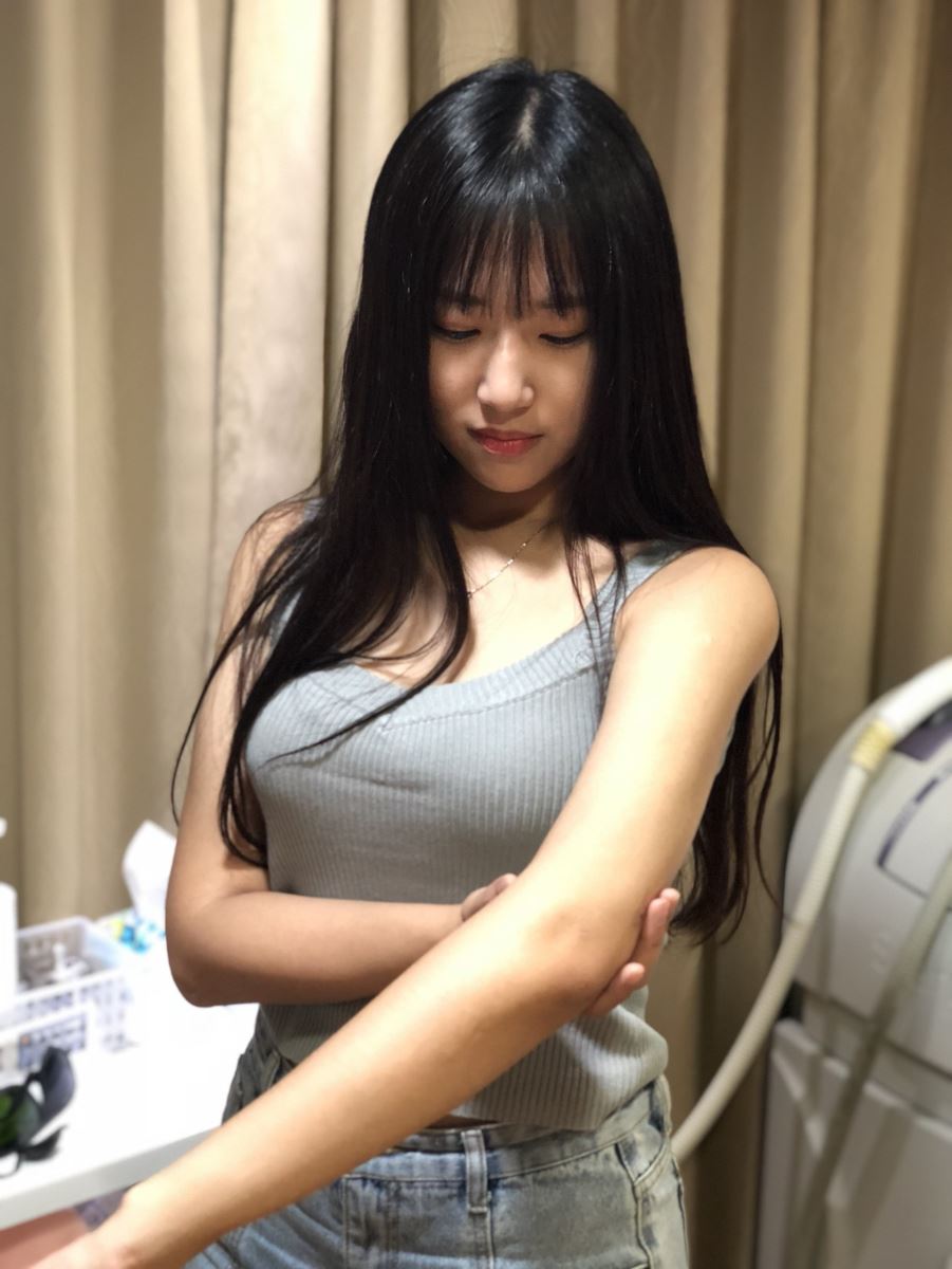 台北手臂抽脂瘦手臂術後一年