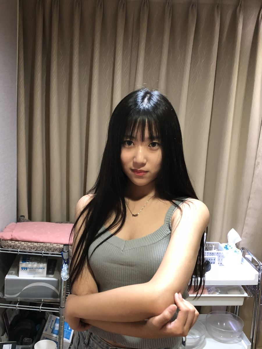 台北手臂抽脂瘦手臂術後一年 台北手臂抽脂瘦手臂術後一年