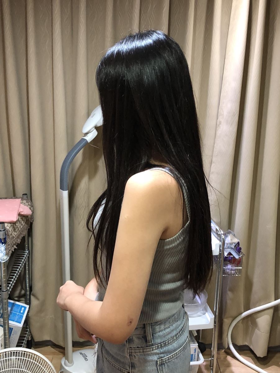 台北手臂抽脂瘦手臂術後一年