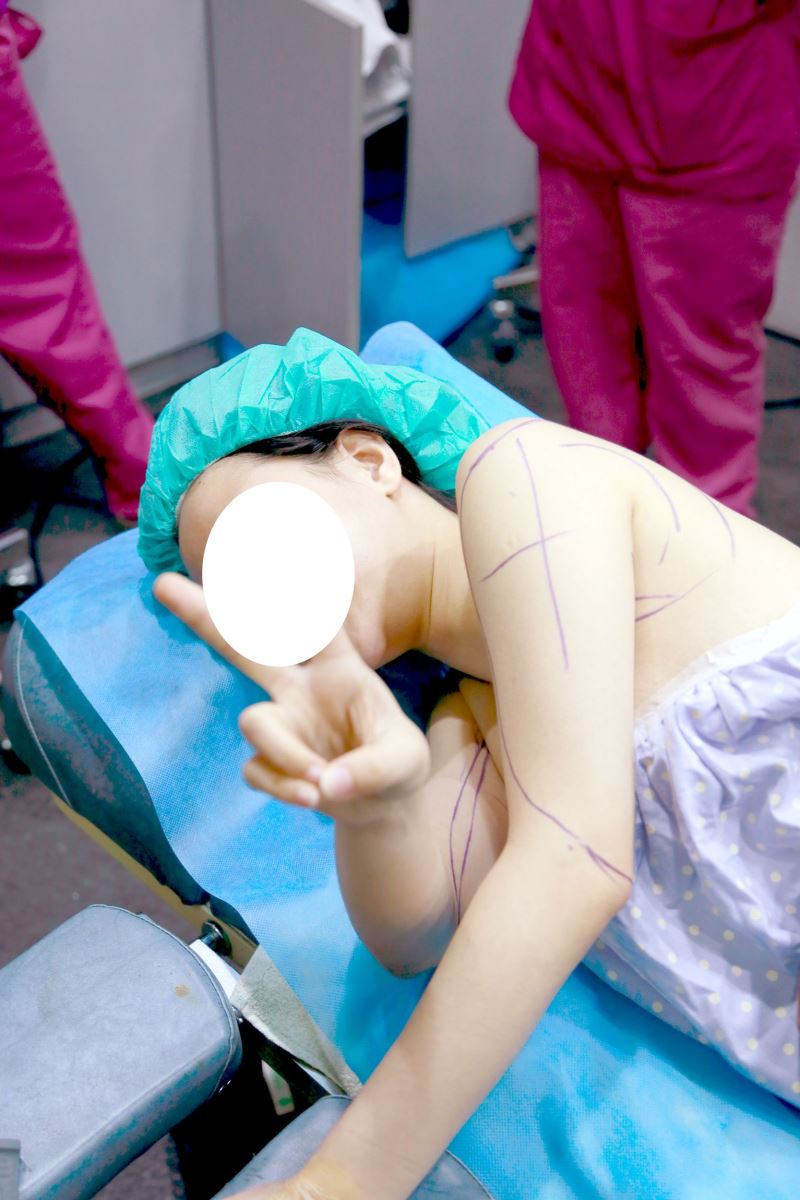 台北手臂抽脂,瘦手臂手術過程照