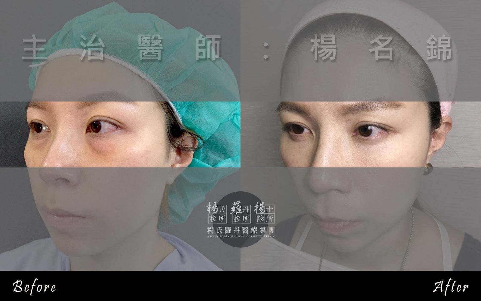 新竹羅丹診所，眼袋淚溝手術，術前術後照