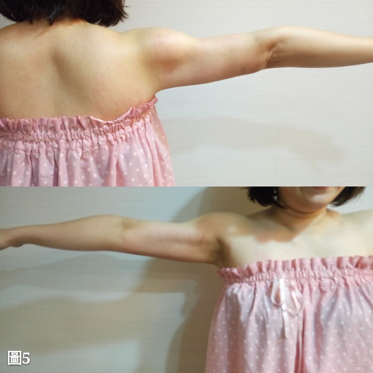 台北，雷射減脂(手臂抽脂)瘦手臂，術前術後照，賴斯敏醫師