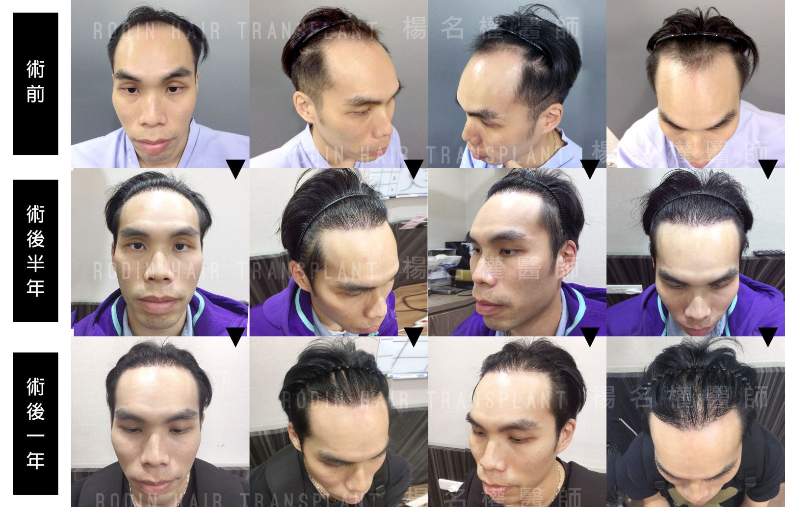 拯救禿頭，羅丹機器人植髮，生髮育髮過程圖