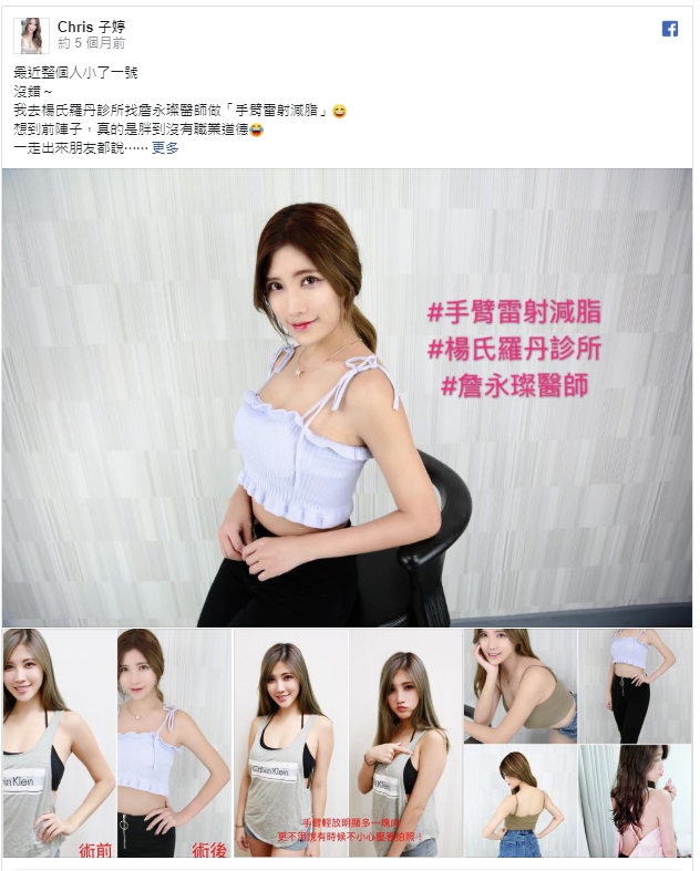 最近整個人小了一號 沒錯~ 我去楊氏羅丹診所找詹永璨醫師做「手臂雷射減脂」😆 想到前陣子,真的是胖到沒有職業道德😂 一走出來朋友都說 :咦?你怎麼胖了一圈? :哇你變好壯喔! :最近是不是吃太好了? 那時候每天心情都好低落😔 每次拍照都用美...