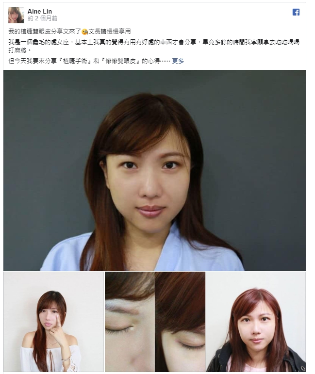 我的植睫雙眼皮分享文來了🧐文長請慢慢享用 我是一個龜毛的處女座,基本上我真的覺得有用有好處的東西才會分享,畢竟多餘的時間我寧願拿去吃吃喝喝打麻將。 但今天我要來分享『植睫手術』和『修修雙眼皮』的心得 植睫,簡單來說就是將自身的頭髮毛囊...