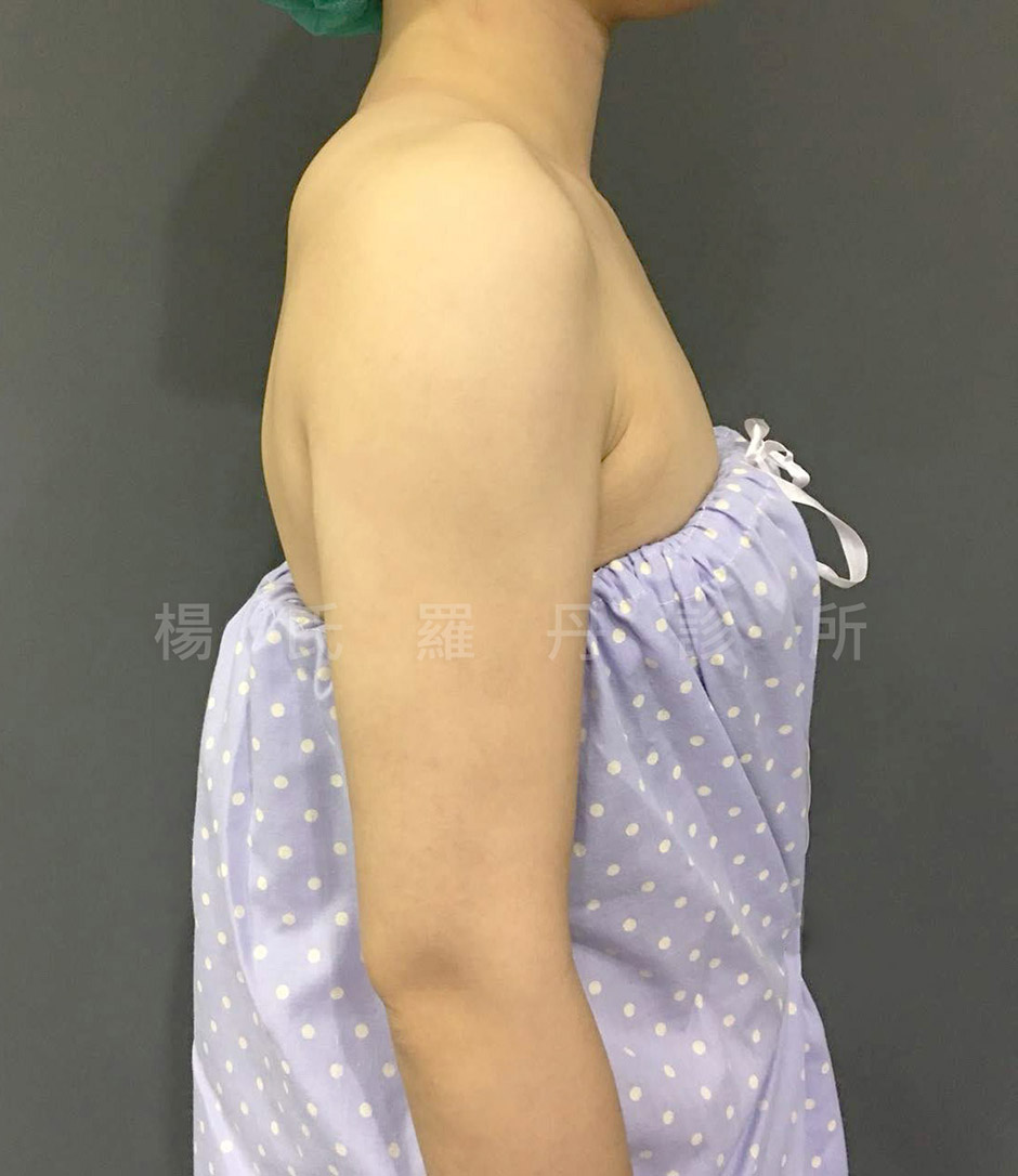 雷射減脂