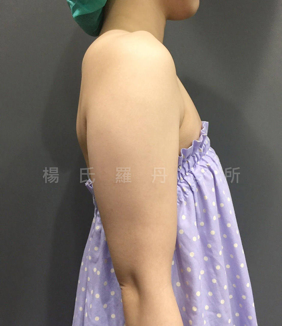 雷射減脂