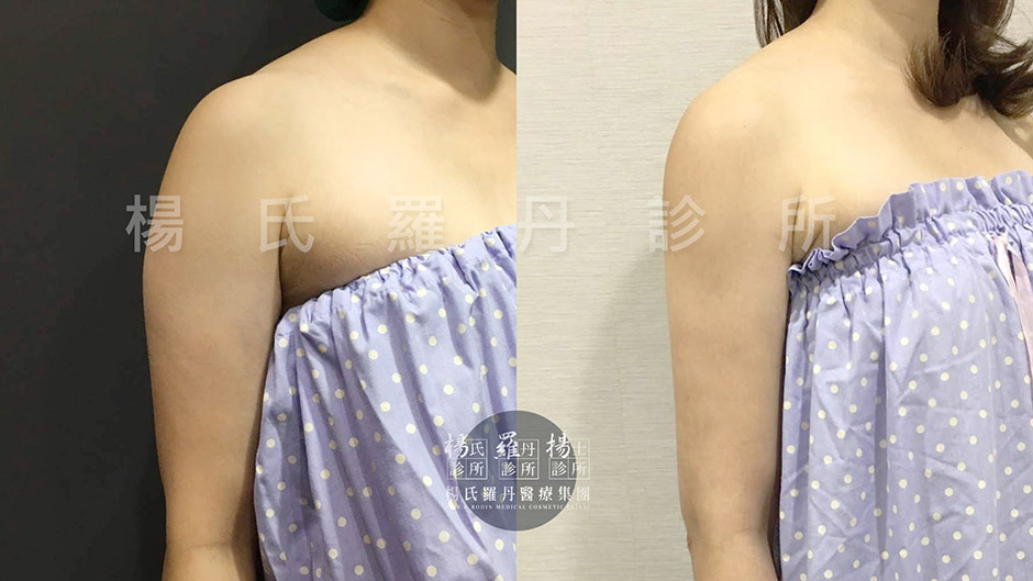 楊氏羅丹雷射減脂