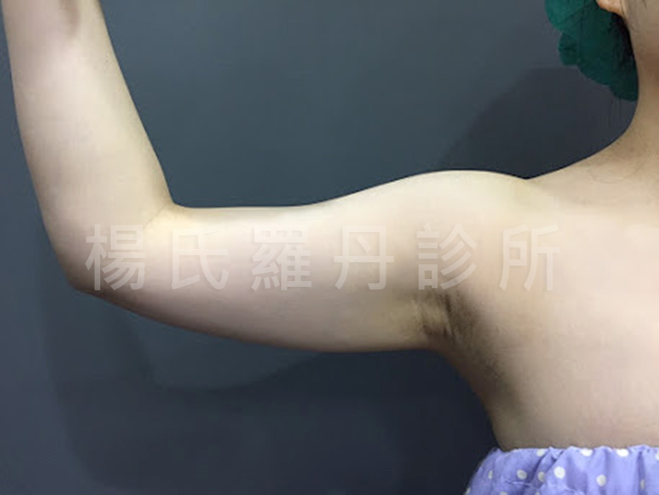 楊氏羅丹雷射減脂