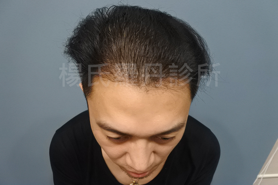 植髮,禿頭,落髮,禿髮