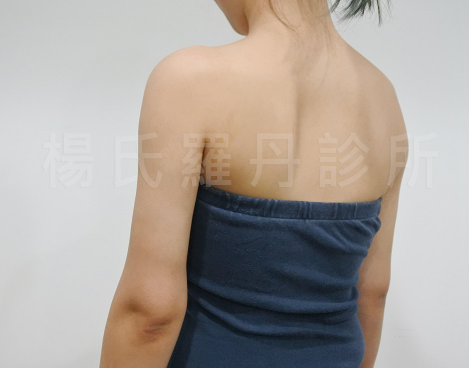 手臂抽脂