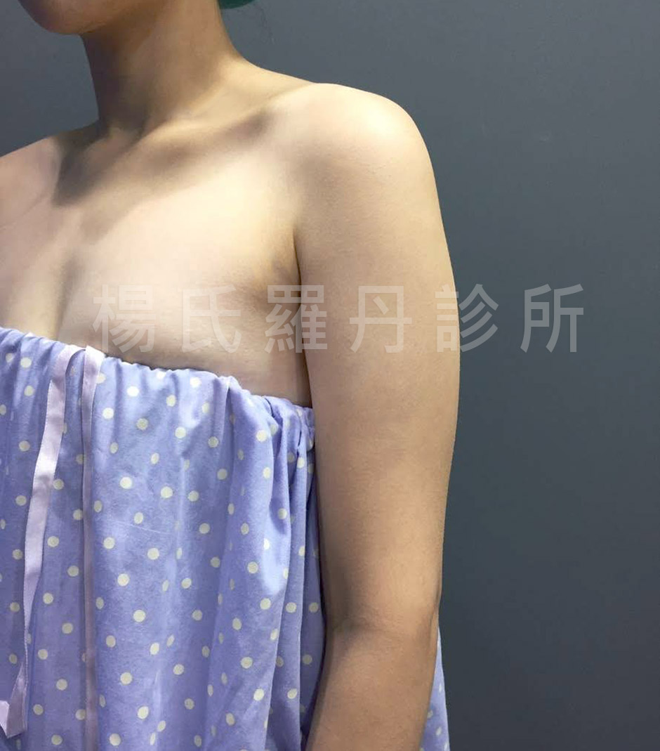 手臂抽脂