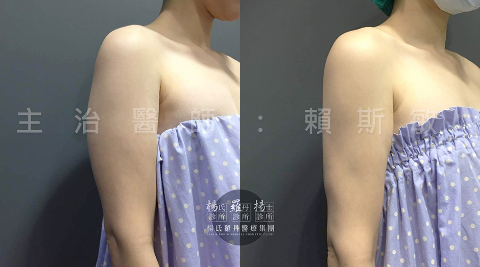 抽脂