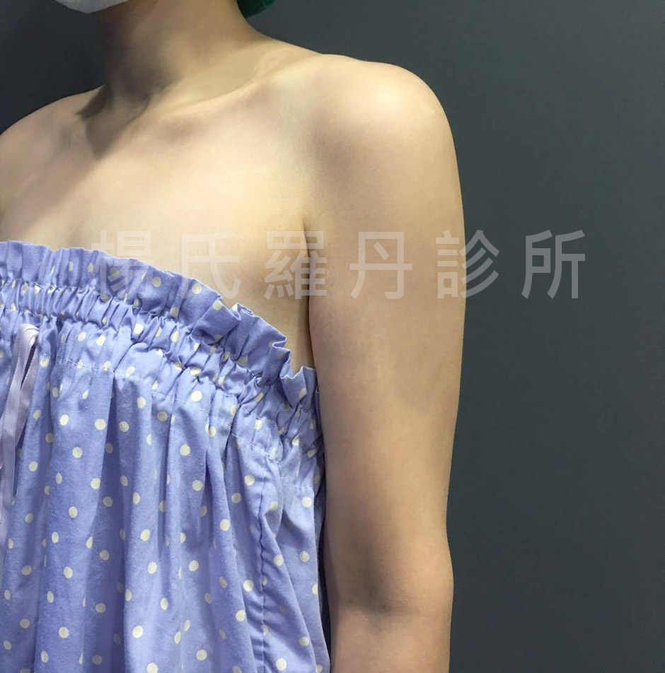 瘦手臂