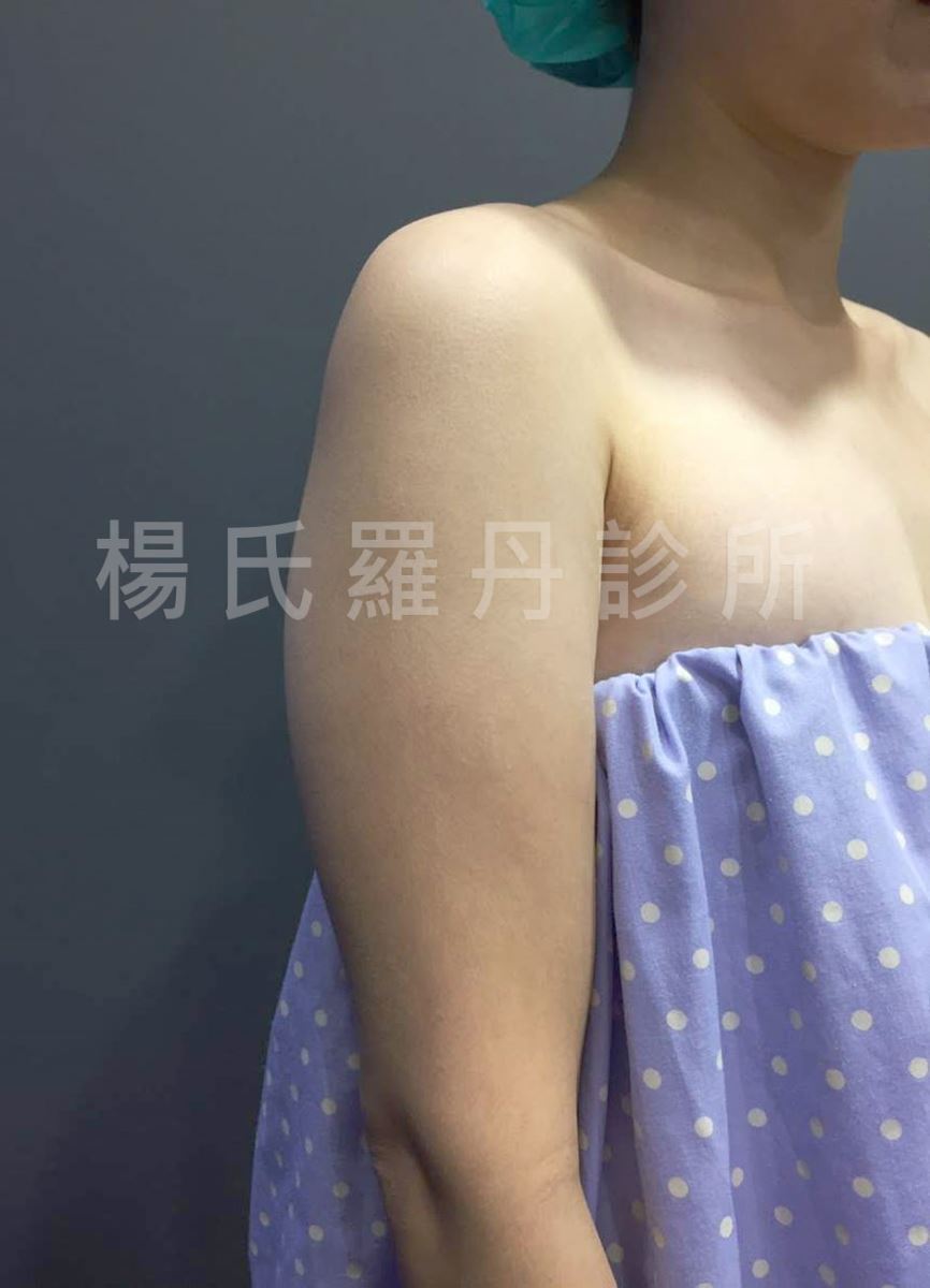 雷射減脂