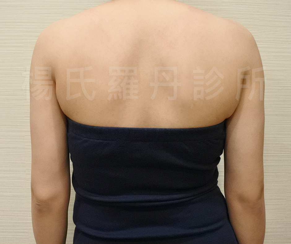 楊氏羅丹雷射減脂