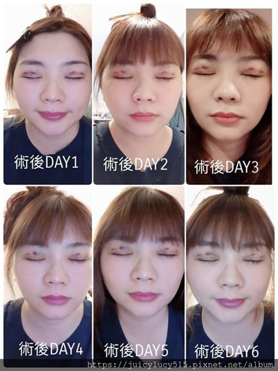縫雙眼皮