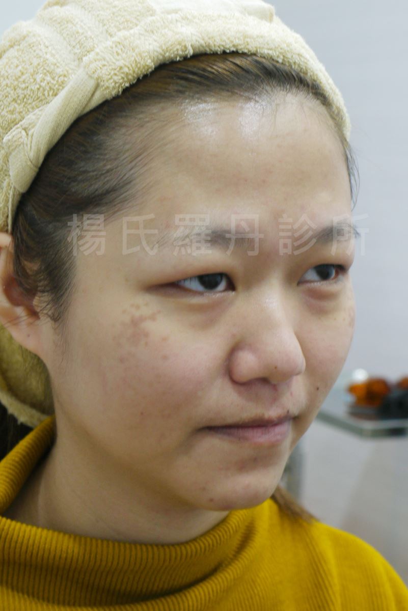案例分享 醫學美容,母斑,案例分享