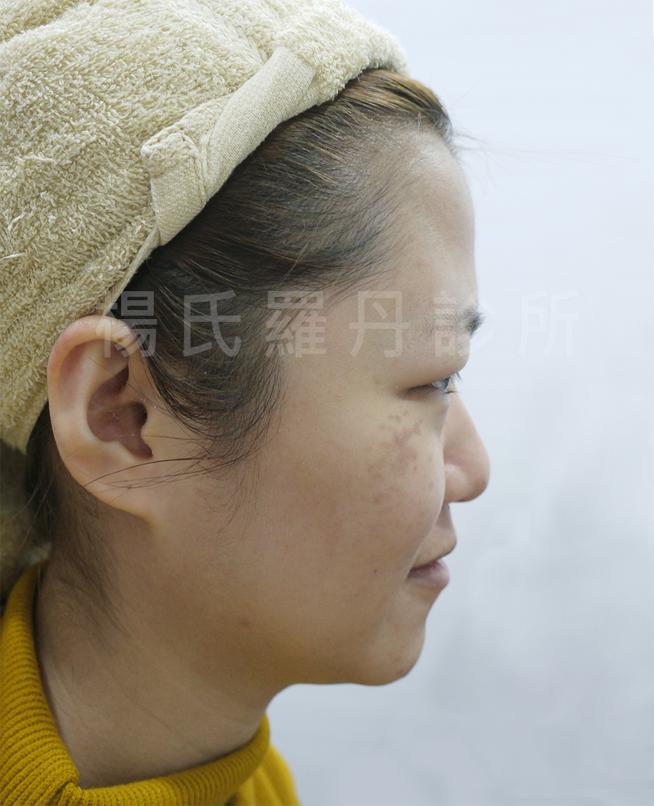 楊氏醫學美容 醫美,母斑,楊氏醫學美容