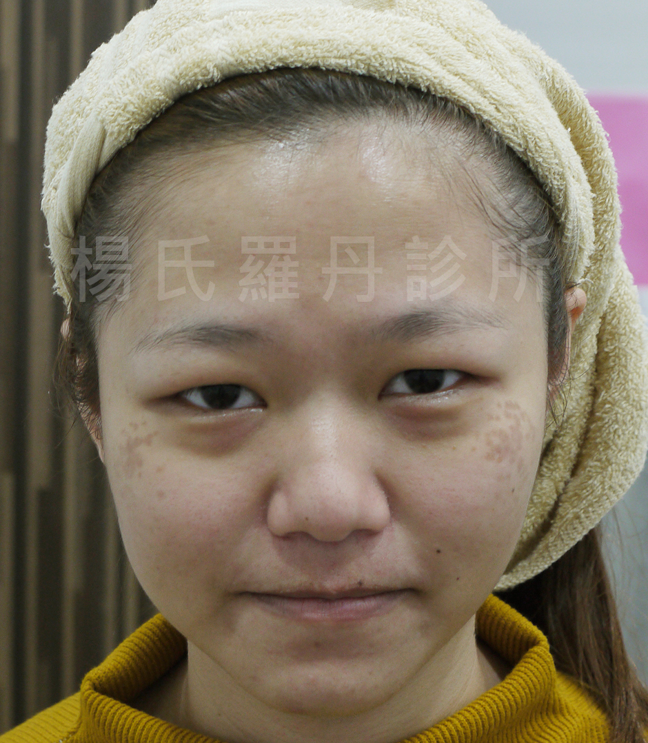 毛孔粗大 醫學美容,母斑,回春,毛孔粗大