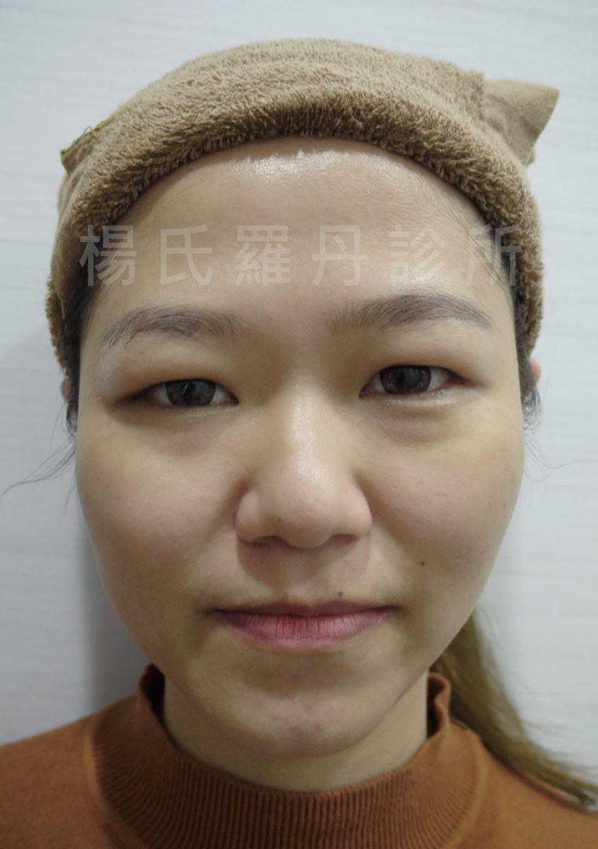 顴骨母斑 醫美,母斑,顴骨母斑