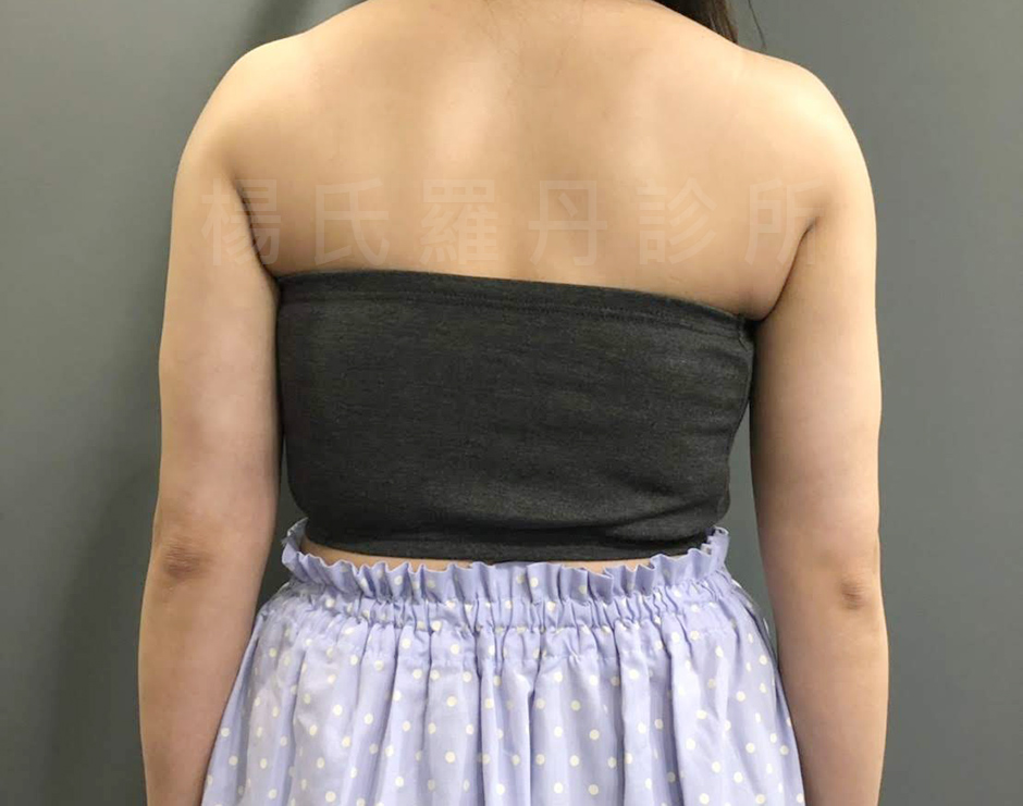 楊氏羅丹雷射減脂