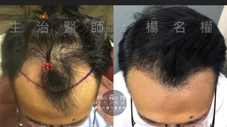 植髮 禿頭 植髮成果 