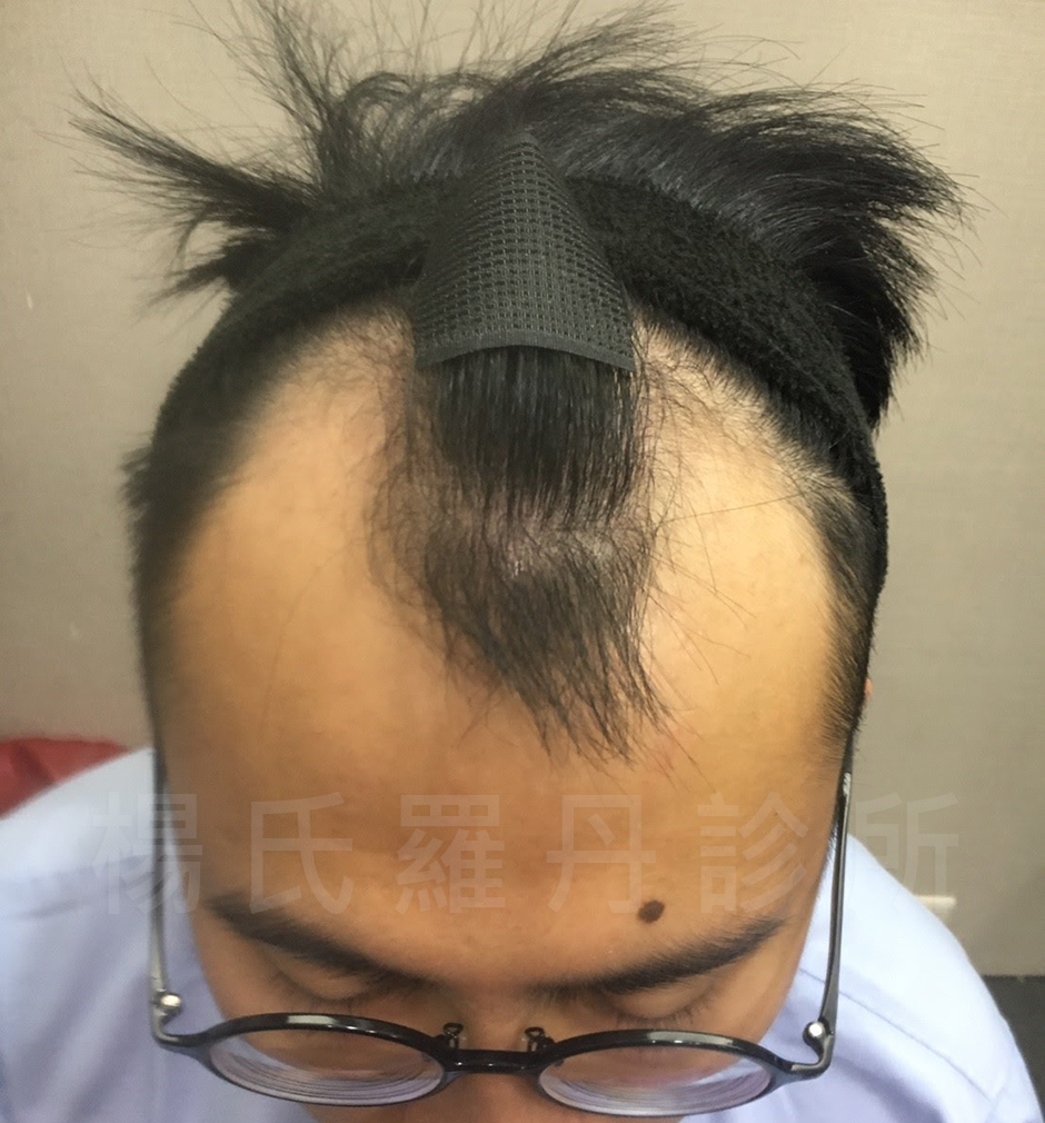 植髮  雄性禿  落髮