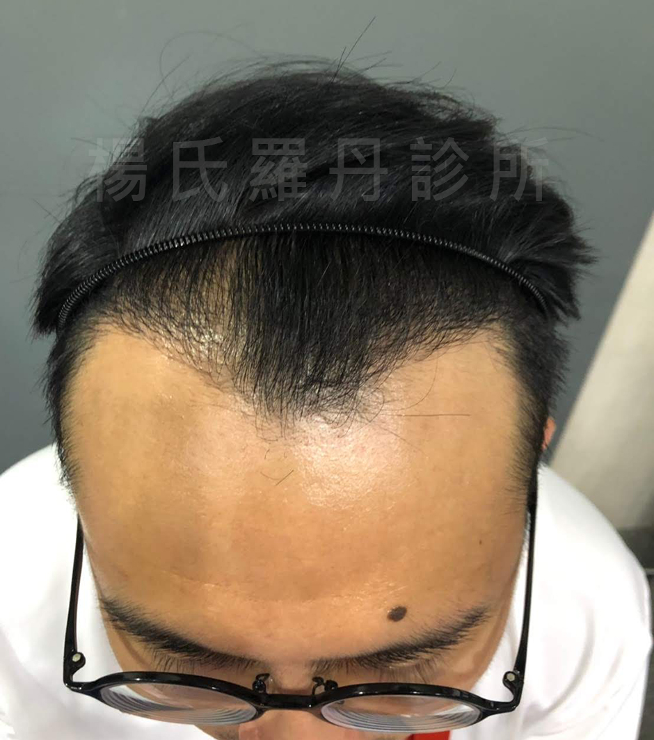 雄性禿 落髮 植髮成果 植髮