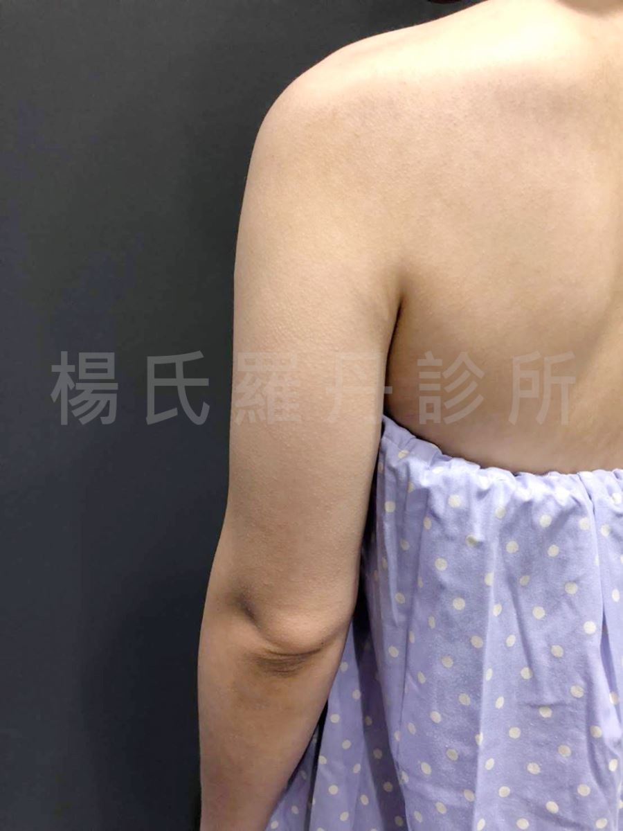 楊氏羅丹雷射減脂