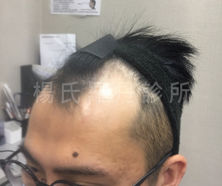 植髮 髮際線 植髮成果