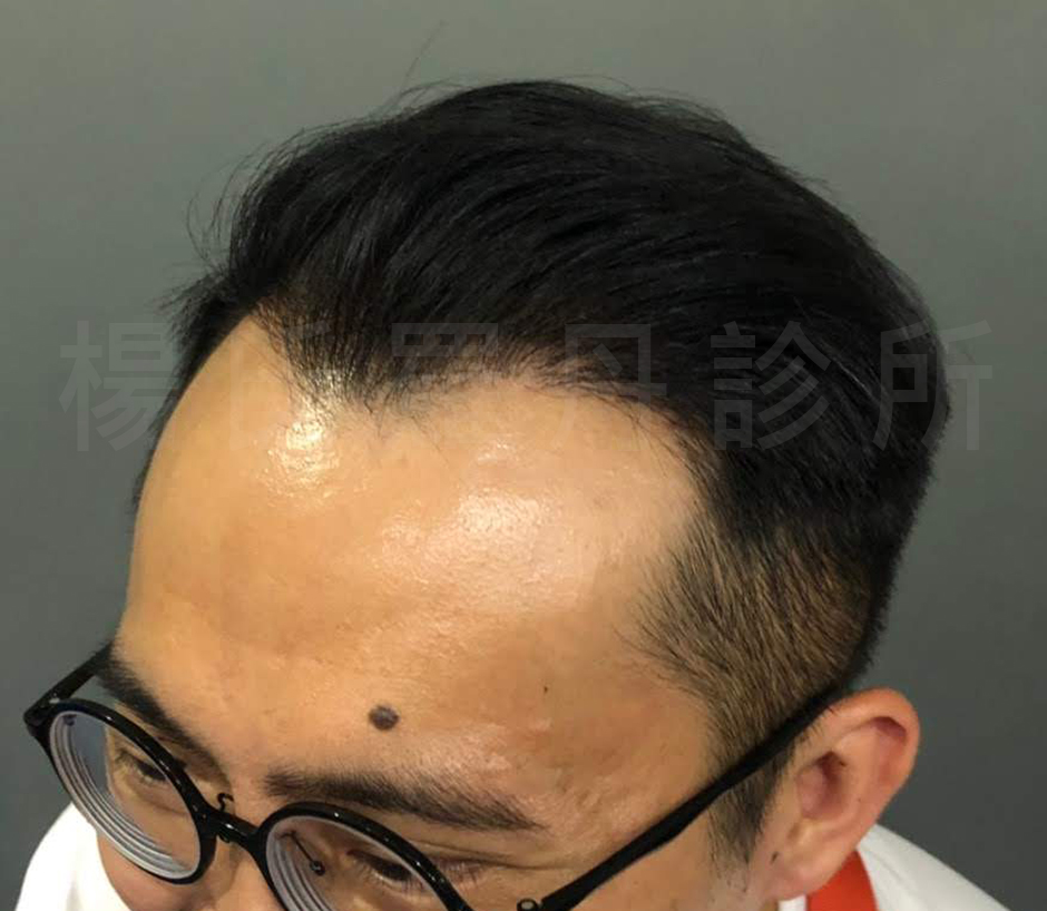 髮際線 落髮 植髮