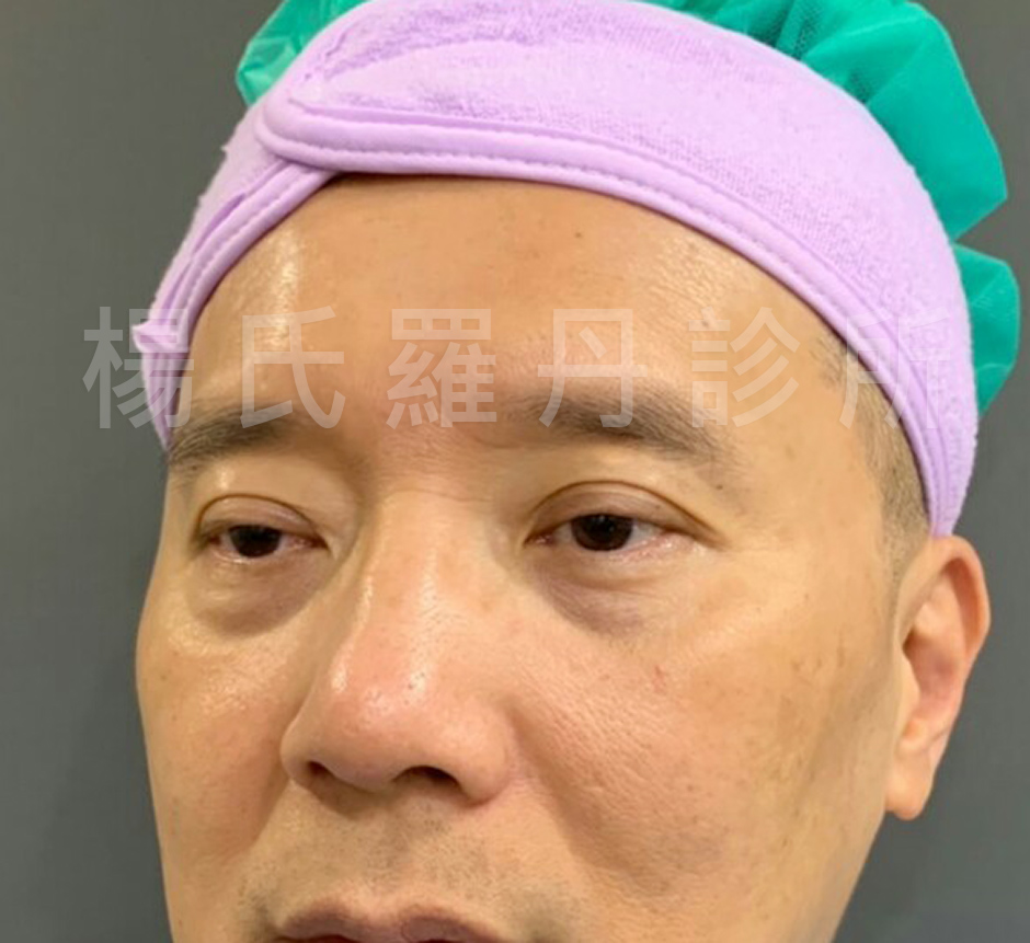 眼袋