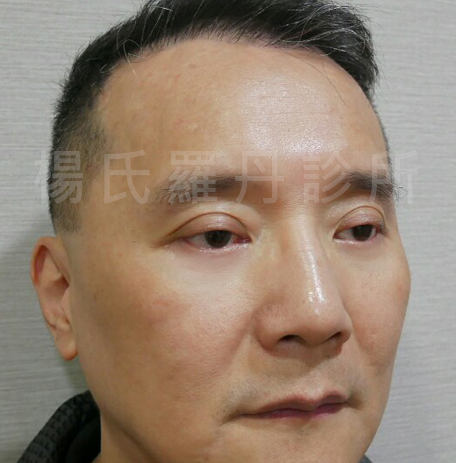 黑眼袋