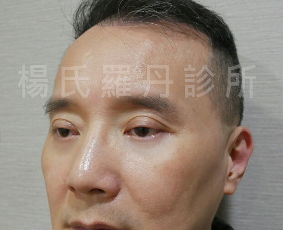黑眼袋