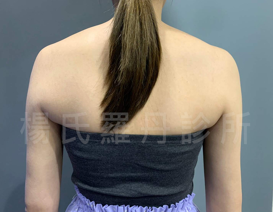 楊氏羅丹 手臂  瘦手臂 掰掰袖 雷射減脂