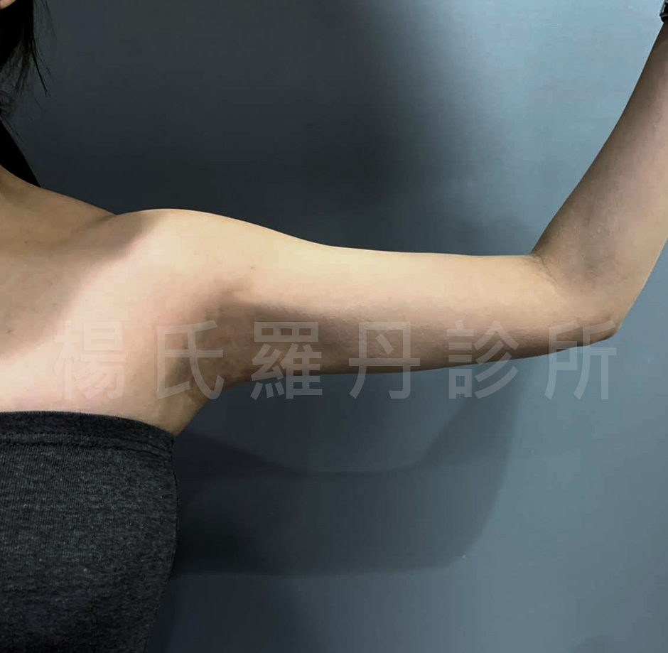手臂 贅肉 雷射減脂 瘦手臂